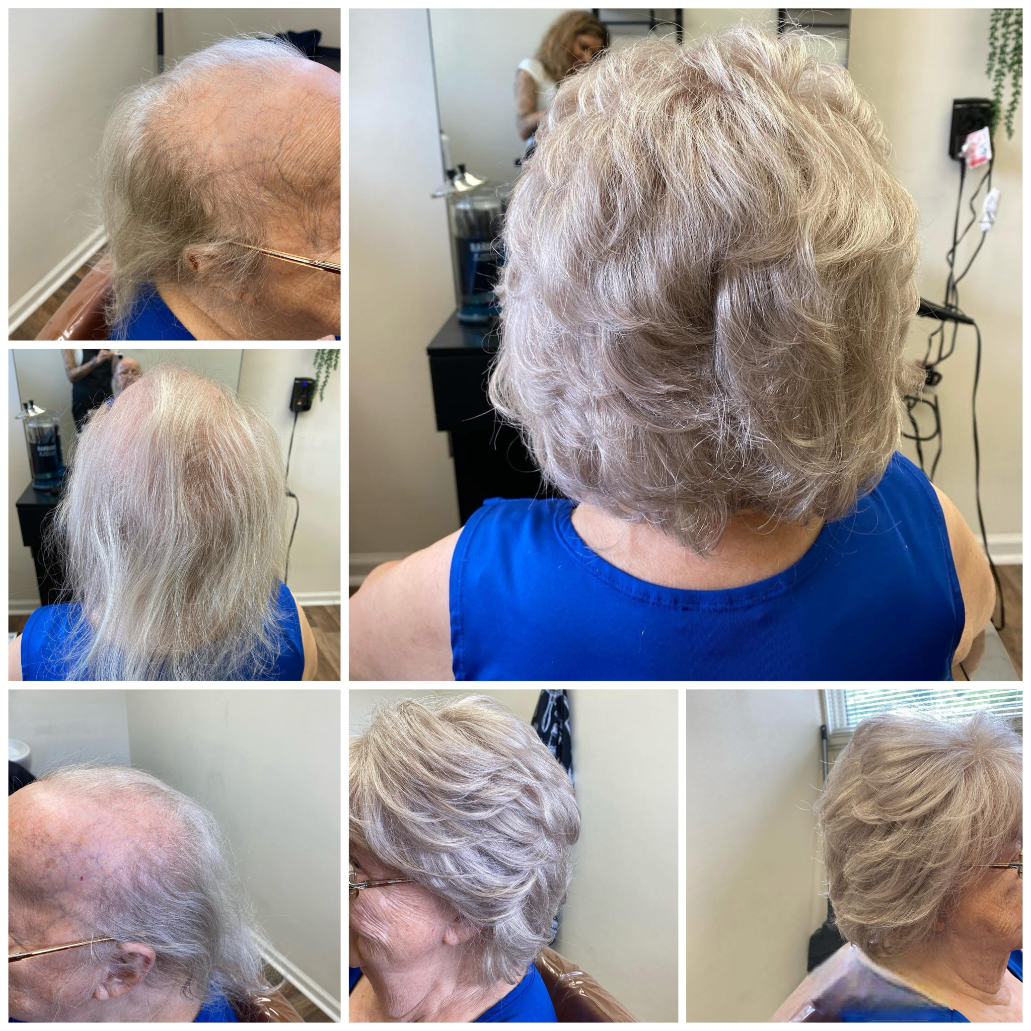 Hair Restoration